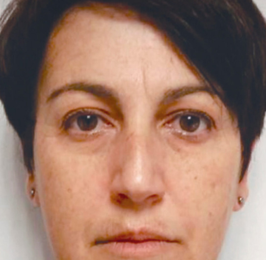 after-wrinkles-under-eye