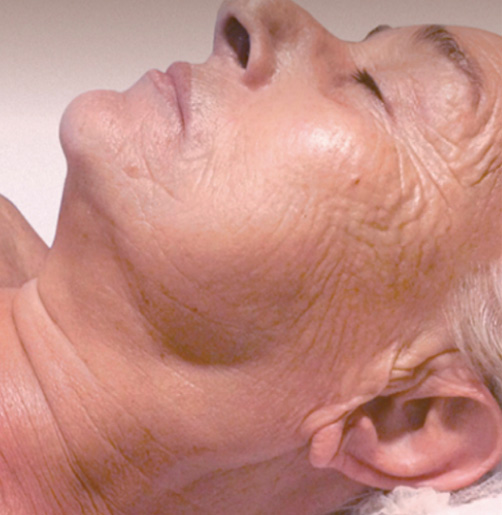 after-wrinkles