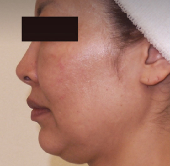 before-double-chin