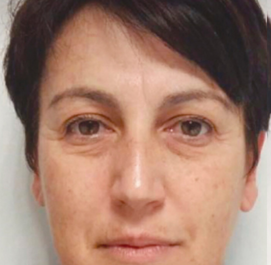 before-wrinkles-under-eye