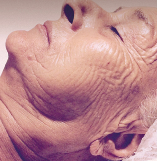 before-wrinkles
